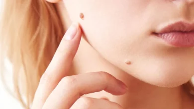 Skin Tag on Nipple
